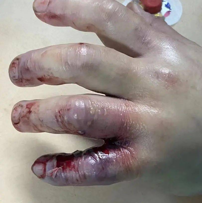 桂林爱吃海鲜的注意了有人被它扎了一下截肢才保住命