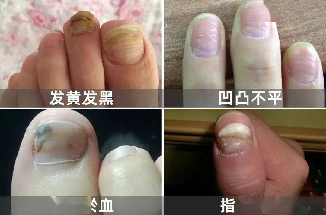 灰指甲又丑又尴尬一个传染俩67每天两滴灰指甲自然脱落长出健康新甲