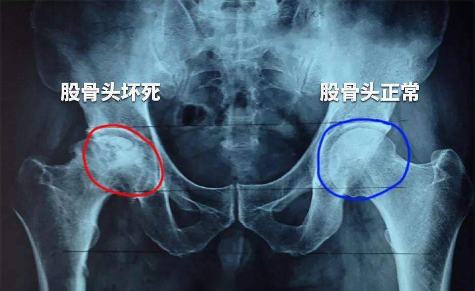 65例患者隨訪75年顯示丨幹細胞有效治療股骨頭壞死