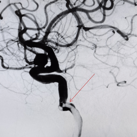 沛嘉加奇嘉介谈丨苏万东tethys03中间导引导管在颈内眼动脉段动脉瘤
