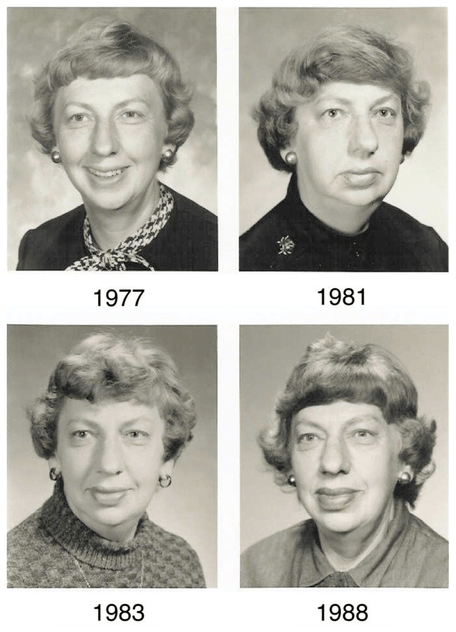 肢端肥大症不但会影响手脚这些"肢端",还会重塑一个人的面部骨骼.