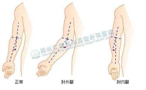 肘过伸15度图片