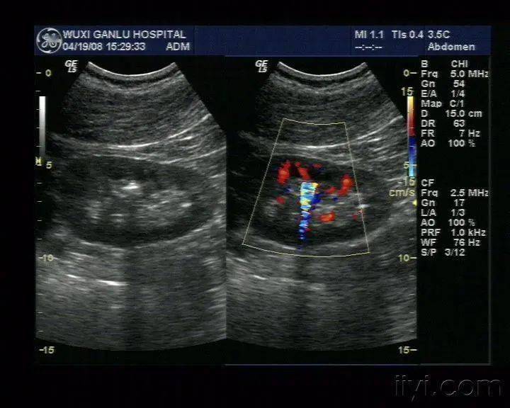 肾结石超声图像输尿管结石超声图像膀胱结石超声图像声明:本文部分