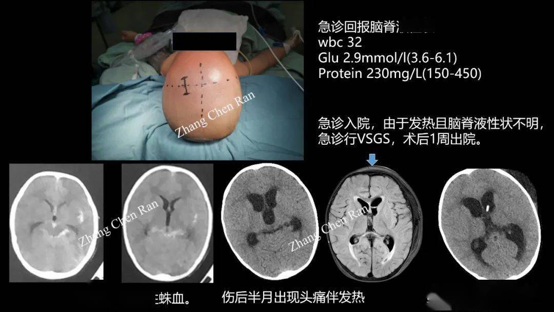 病例分享腦室帽狀腱膜下分流術在腦室內出血後腦積水中的應用心得分享