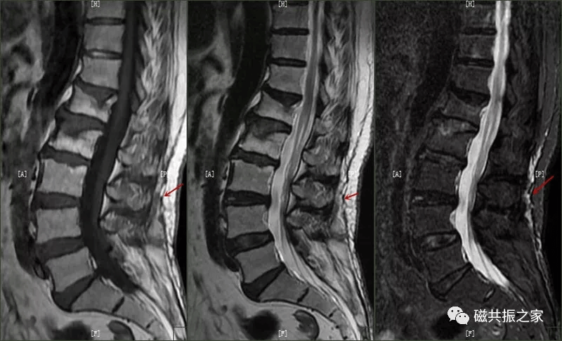 在压脂t2wi图像上棘间韧带信号增高(正常韧带表现为t1wi和t2wi均呈低