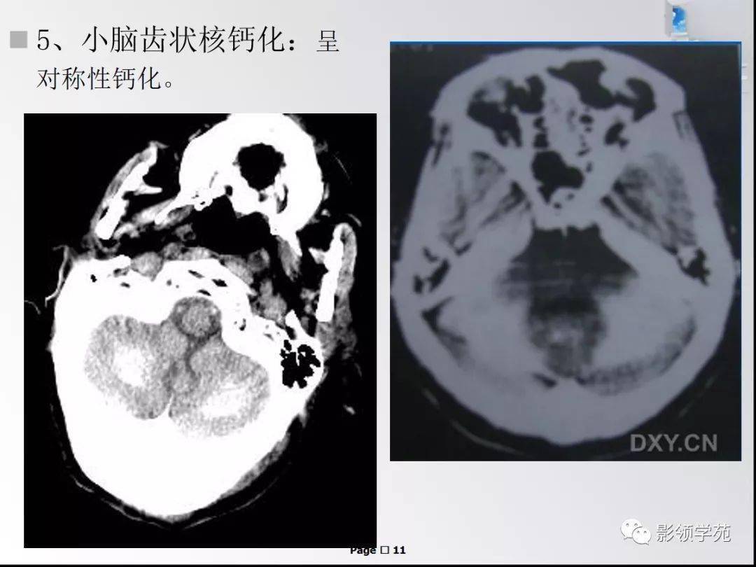 Ⅱ度:ct明显钙化,平片无异常所见;i度:仅ct发现钙化;松果体区钙化分四