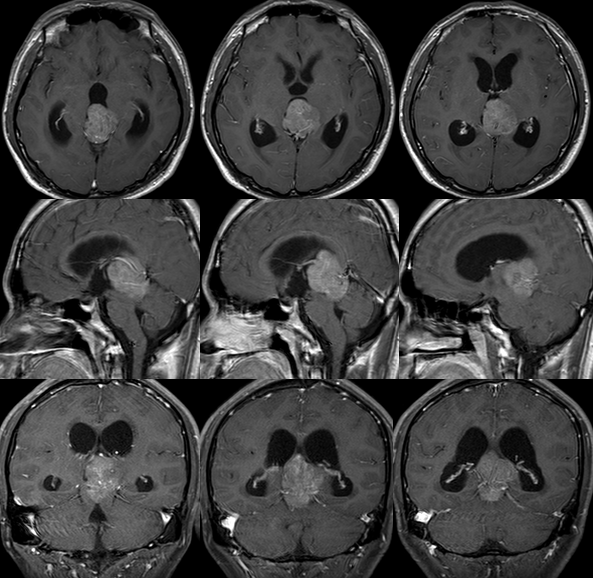 三脑室肿瘤图片