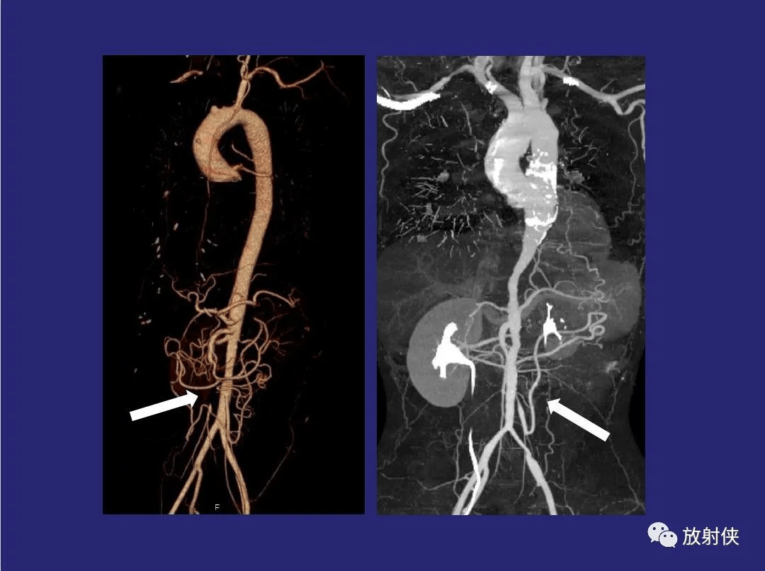 精品大动脉炎分型及ct诊断