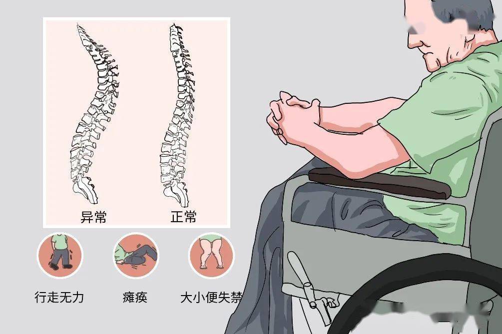 并发截瘫的脊柱结核