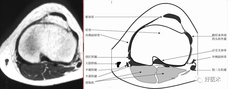 半月板解剖及损伤的详细图解