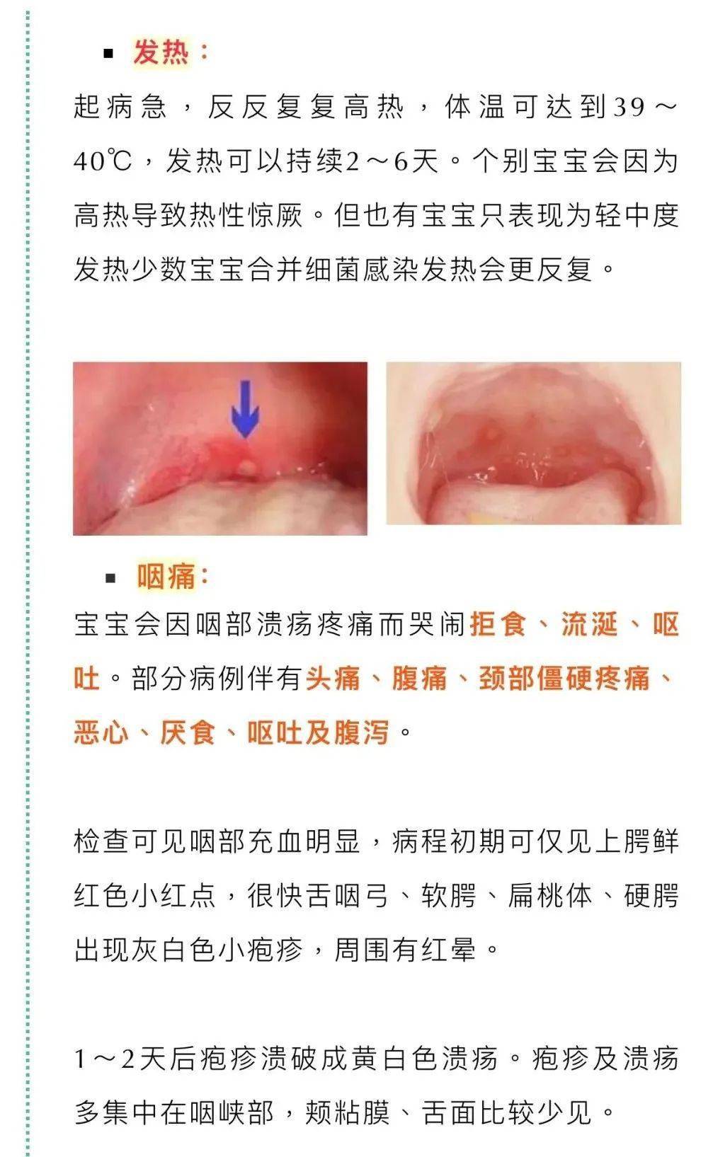 疱疹性咽峡炎会发烧吗图片