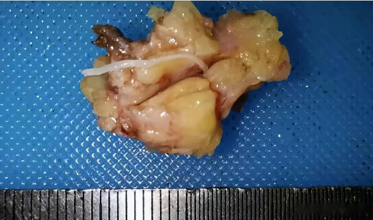 活检以进一步明确诊断,最终的病理显示,孙先生体内确实存在曼氏裂头蚴