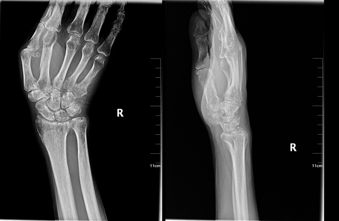 晨读结果公布20210616肌骨系统疾病tfcc损伤