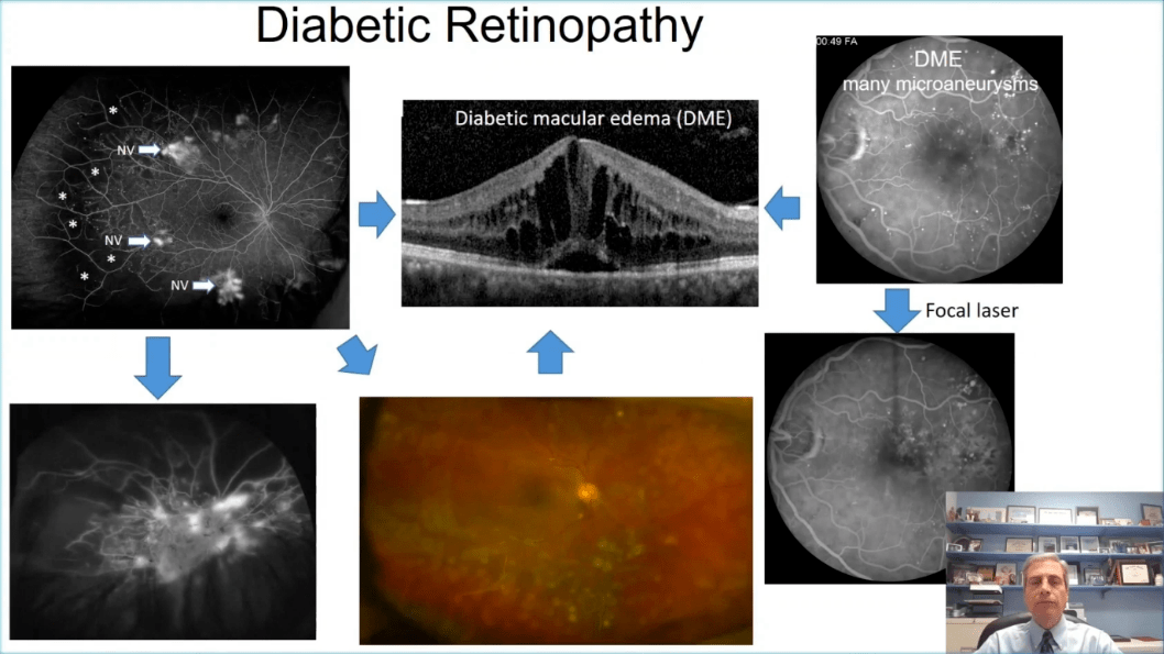 neuroretinopathy图片