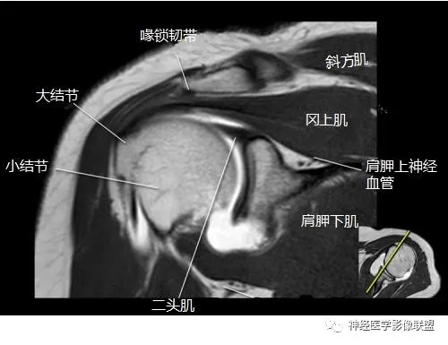 肩关节核磁解剖图图片