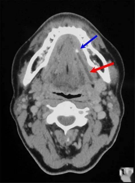 涎石症影像学诊断