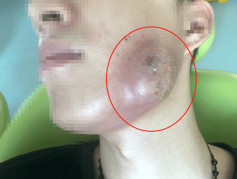 图片高能 广西男子不拔智齿 脸肿起脓包 脓包里有菜叶米粒 医生