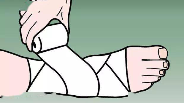 在肿胀得到冰敷控制之后,可以适当地使用绷带等物品对受伤处的远心端