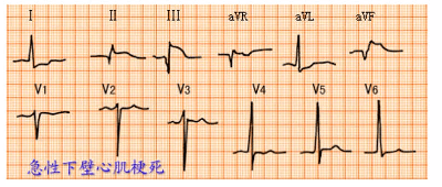 这6种常见心电图你一定要学会