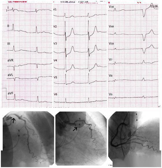 有人发现v7-9导联可以提高急性心肌梗死诊断的敏感性,将其对应的左