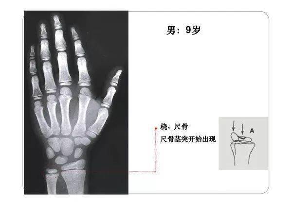 收藏必备丨骨龄图谱修正版