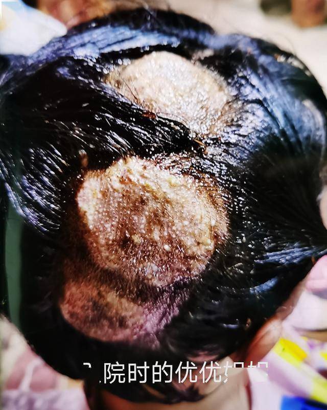 头皮发麻姐弟俩先后因脓癣入院问题竟出在家里来的新成员