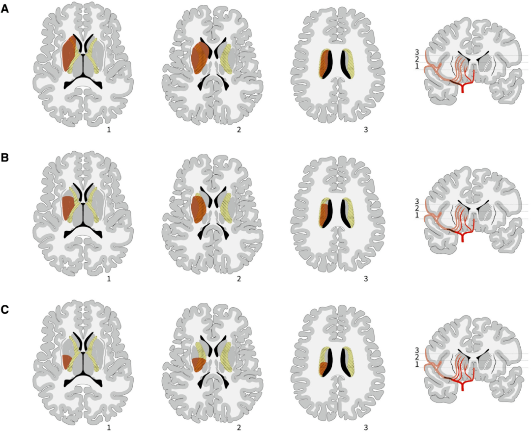stroke内囊梗死的模式与预后