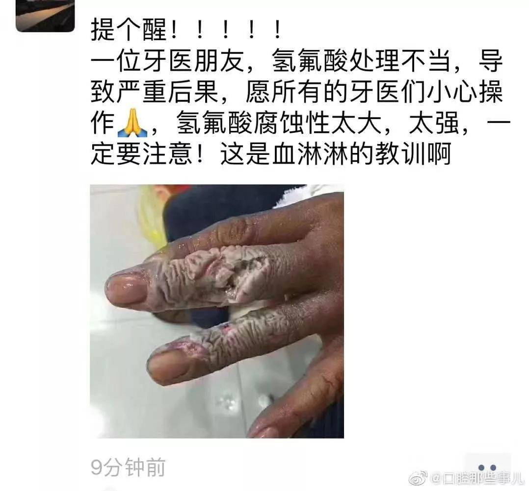 导致手指被腐蚀:氢氟酸,是在口腔治疗时常用的试剂