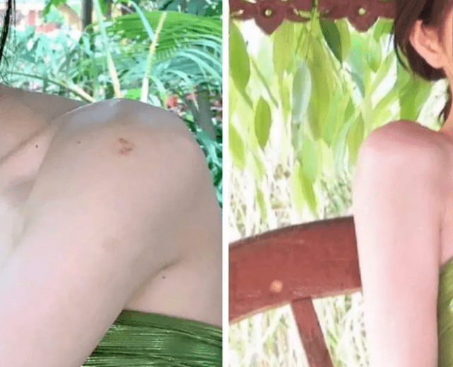 鞠婧祎肩头比逆袭路,消除斜方肌时刻端肩,却因淤青被质疑打针?_肩膀