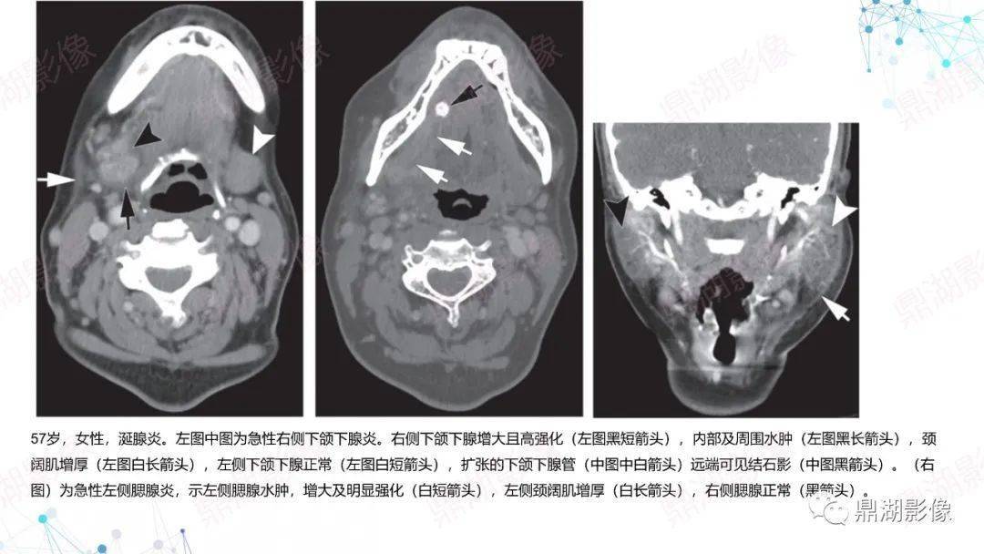 颌下腺断层解剖图片图片