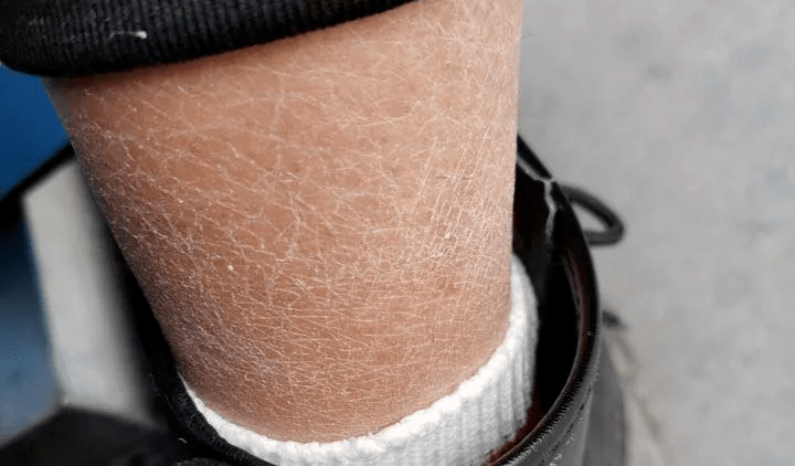 而若不注重补水保湿,很容易伴发"鱼鳞病",也就是常说的"蛇皮肤"