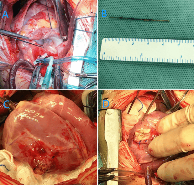 当一根长针扎进心脏1个月以上人还活着怎么取出针bmc期刊病例报道