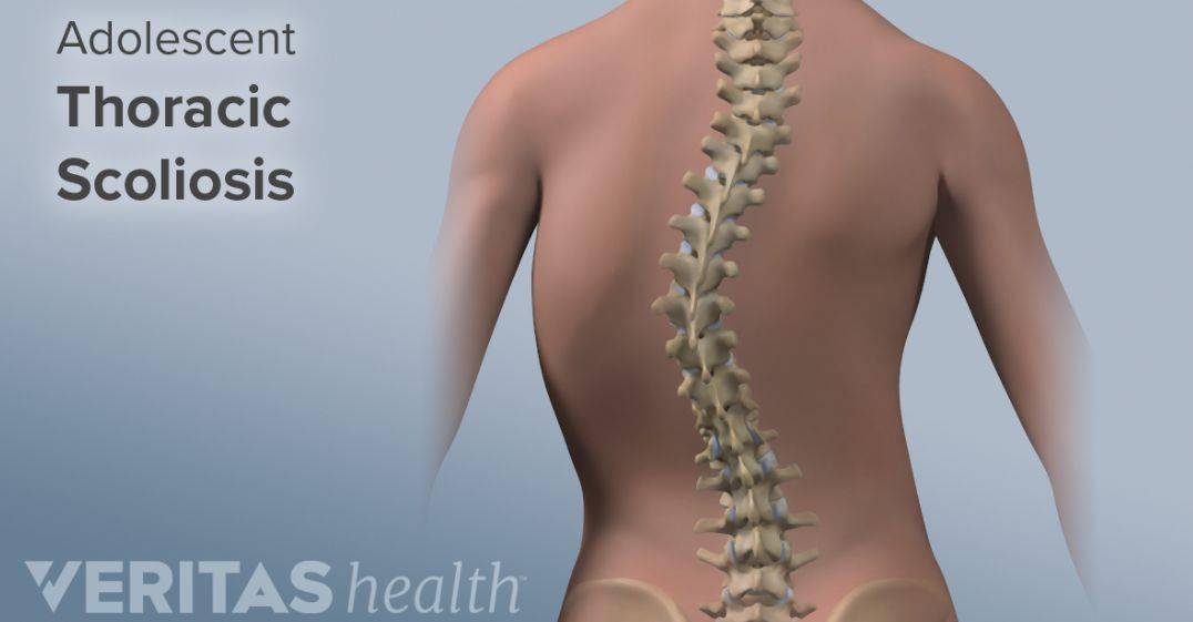 任何累及神经和肌肉的疾病均可导致脊柱侧凸,最常见的原因是由于肌肉