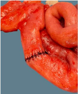 5年穿孔4次!这个患者的小肠到底有什么问题?