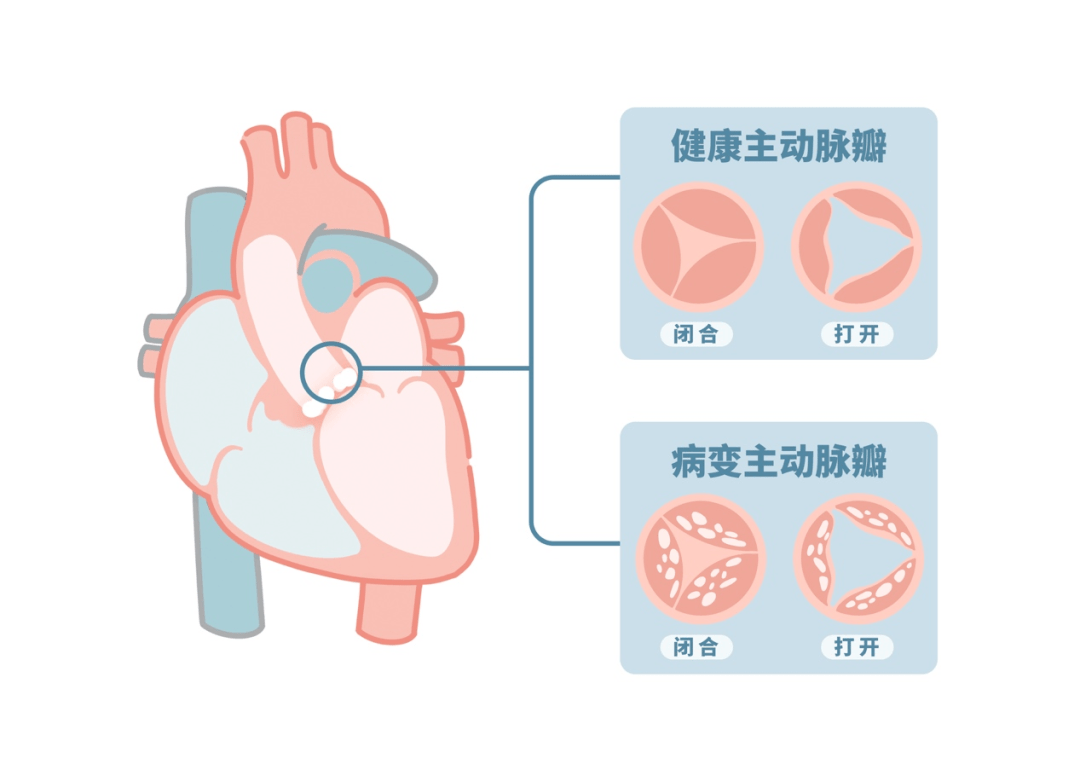 当瓣膜钙化僵硬后,主动脉瓣将变得狭窄,无法充分开放.