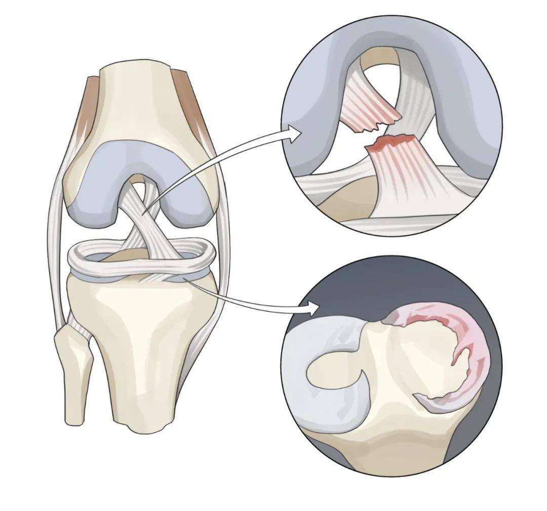 它有三個我們在臨床上要反覆打交道的重要結構——半月板,軟骨和交叉