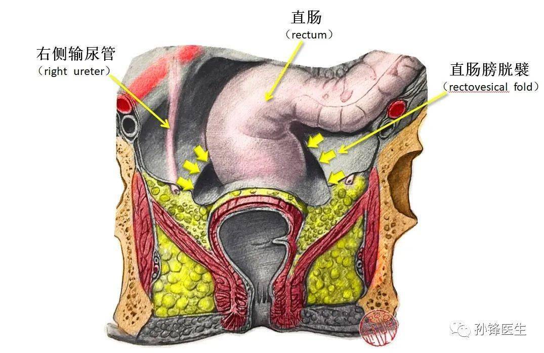 男性直肠膀胱陷凹图片