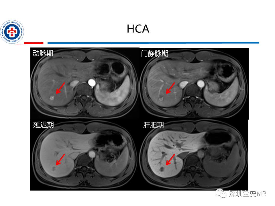 肝脏常见肿瘤mri诊断与鉴别诊断