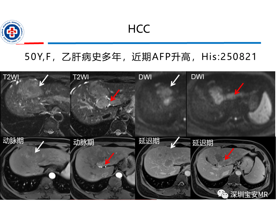 肝脏常见肿瘤mri诊断与鉴别诊断