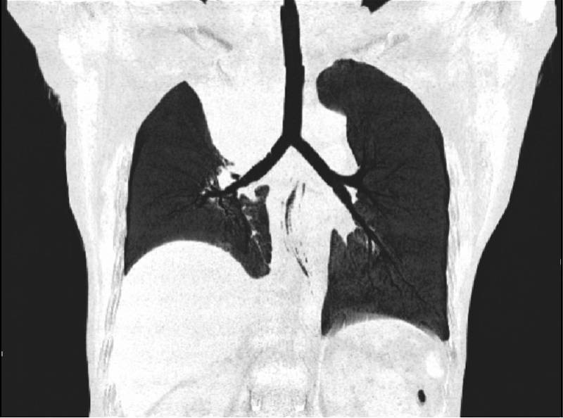 支气管|成排假牙掉进气道，肿瘤堵塞支气管……支气管镜开路悉数疏浚