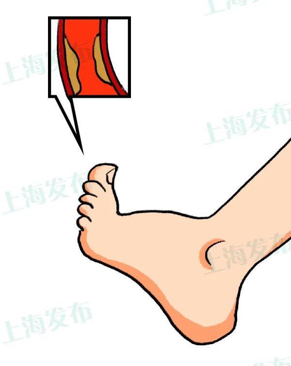 足部|【医聊】血糖高为啥烂jio？操劳一生的脚需要特别的爱！