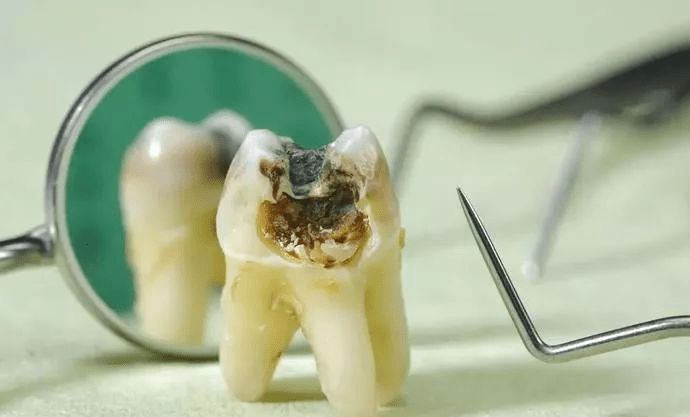 梦回齿间，解析一只牙变黑细小，貌似掉落的梦境寓意