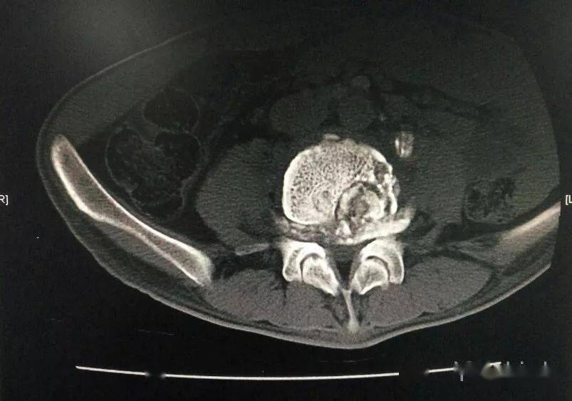 边缘型腰椎结核_诊断