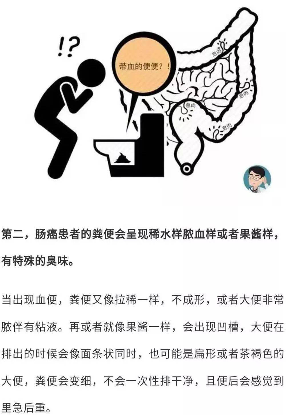 得腸癌的人排便會出現這3個現象