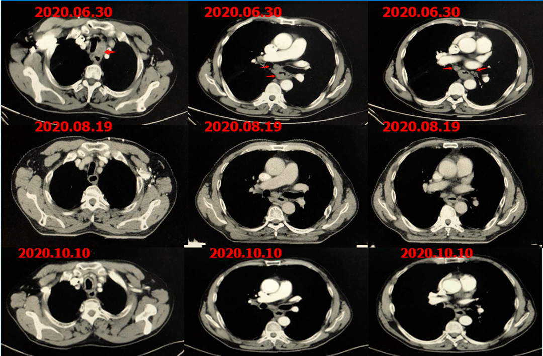 快速缩瘤持续获益免疫治疗为晚期食管鳞癌患者开启新的治疗时代