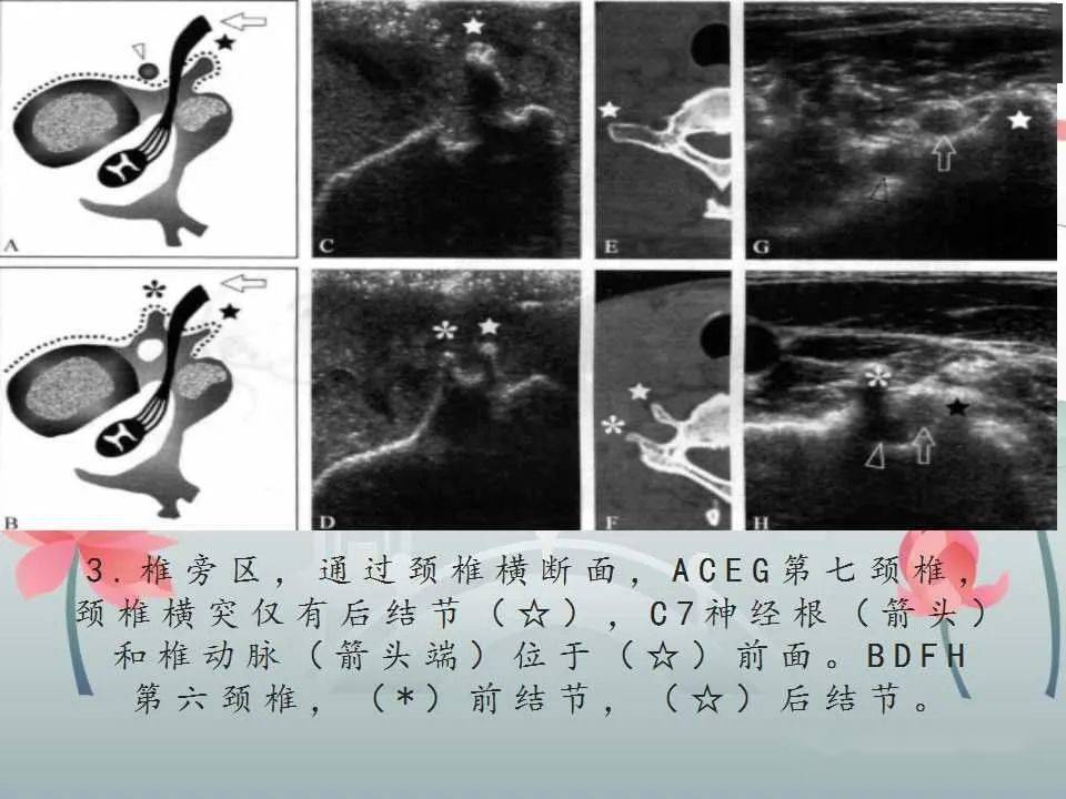 文献阅读与病例讨论臂丛神经的解剖与超声扫查
