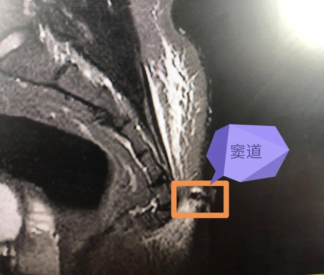 別再久坐啦小心屁股長帶毛化膿的痘痘