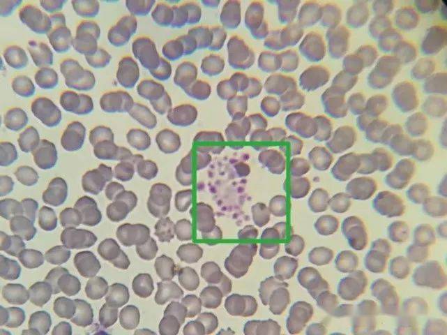 载玻片上,加上盖玻片静置片刻,高倍镜镜检发现有血小板聚集现象(图二