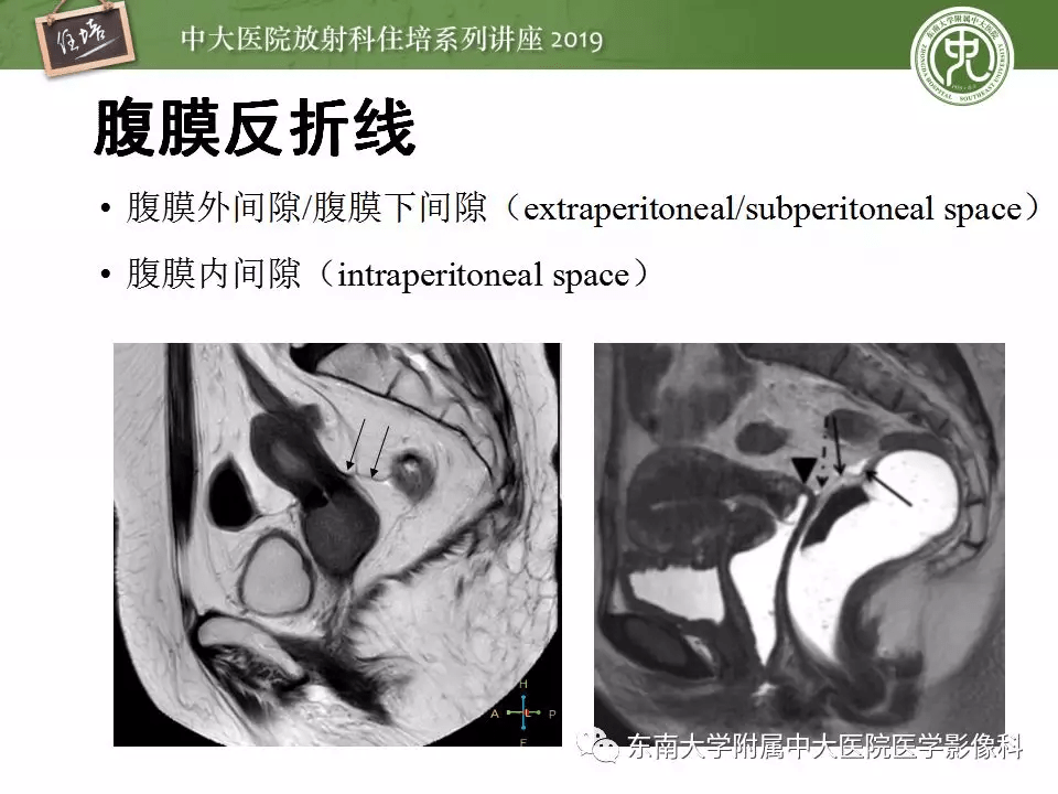 子宫MR解剖图片