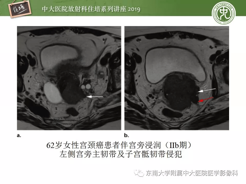 子宮詳細解剖及磁共振信號分析